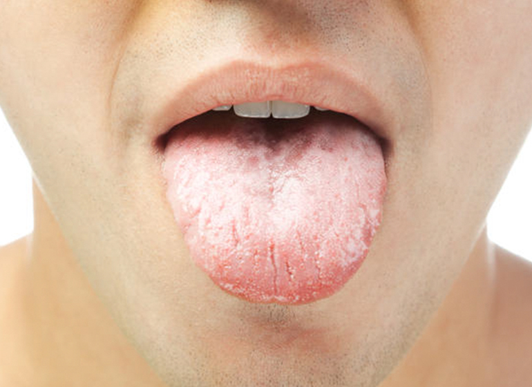 Cara menghilangkan pahit di mulut saat sakit
