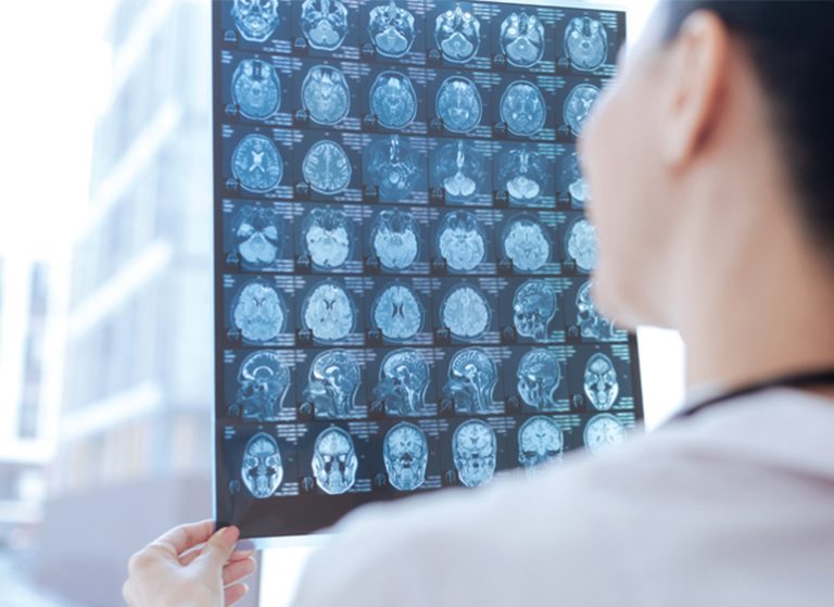 Tumor Otak , Kenali Sejak Dini Sebelum Terlambat