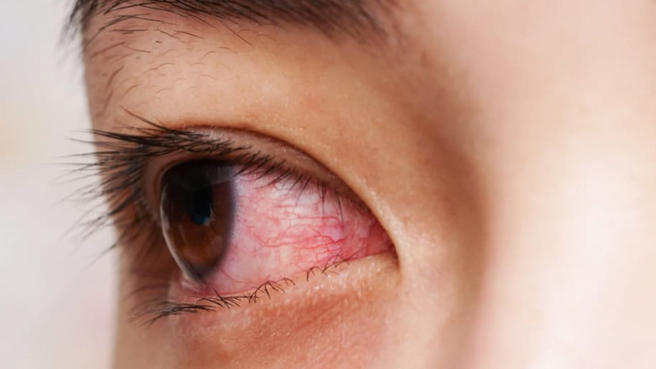 Berbahayakah Mata Belekan Terlalu Sering Monitor